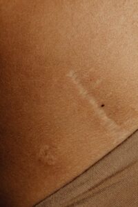 Jak powstają przebarwienia skórne